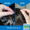 dermasolve-eczema-relief-shampoo---flare-3.jpg